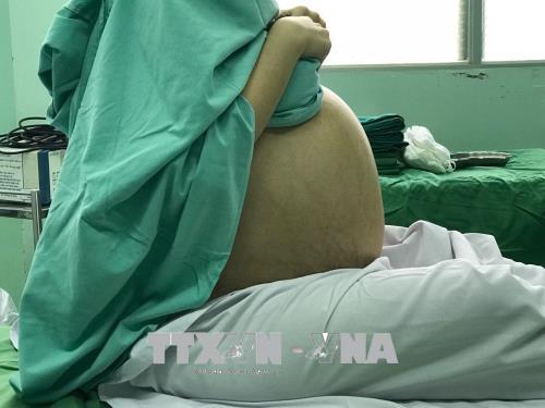 Cô gái 20 tuổi bị khối u buồng trứng nặng 18kg 